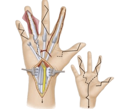 Synovectomy of Hand