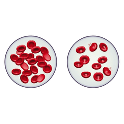 Thalassemia