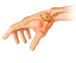 Thumb Arthroplasty