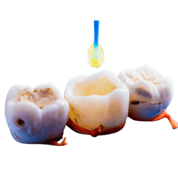Tooth Colored Filling - White Fillings