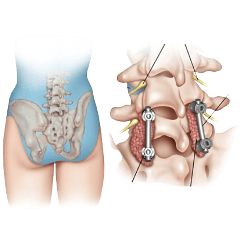 Transforaminal Lumbar Interbody Fusion - TLIF (Bel teshigidan o'tkaziladigan bel bo'limi interbody fiziyasi)