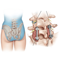 Transforaminal Lumbar Interbody Fusion - TLIF (Bel teshigidan o'tkaziladigan bel bo'limi interbody fiziyasi)