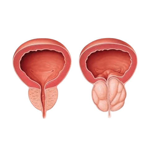Prostataning transuretral rezeksiyasi - TURP