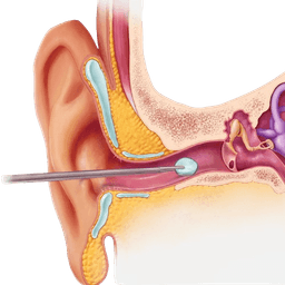 Tympanoplasty- Eardrum Repair