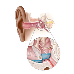 Tympanostomy tube insertion