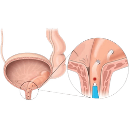 Ureterocele