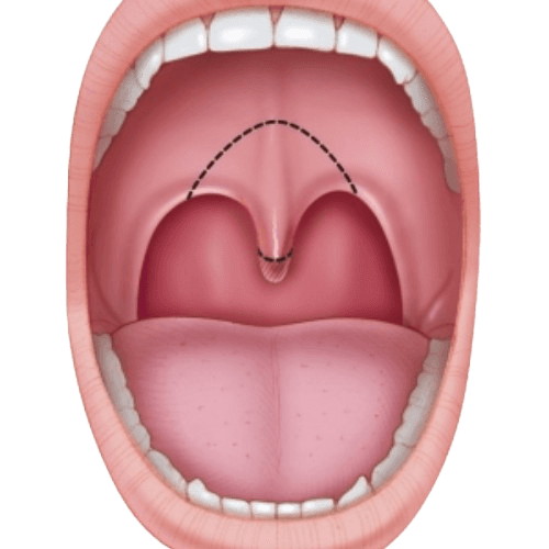 Uvulopalatofaringoplastika (UPPP)