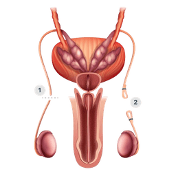 Vasectomy Reversal