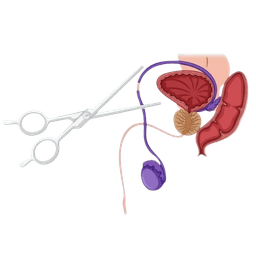 Vasectomy