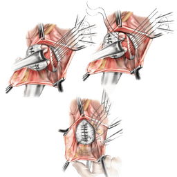Anterior Posterior Repair Colporrhaphy