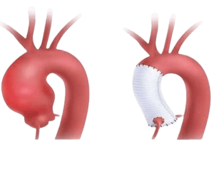 Aortic Root Replacement