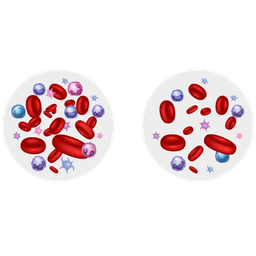 Aplastic Anemia