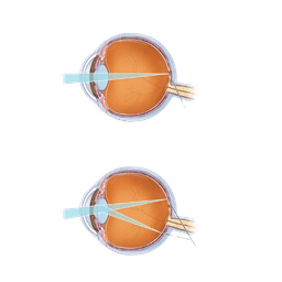 Astigmatism