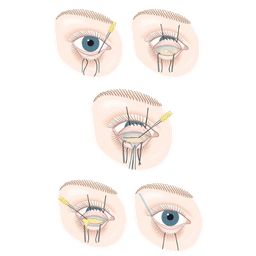 Blepharoplasty Eye Lid Surgery