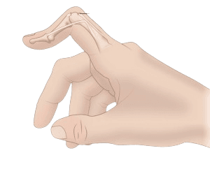 Boutonniere Deformity