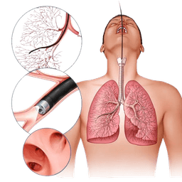 Bronchoscopy