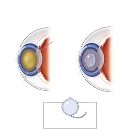 Cataract Surgery