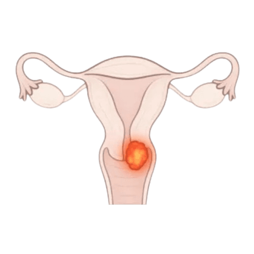 Cervical Cancer