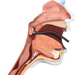 Coblation Tonsillectomy