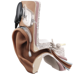 Cochlear Implantation