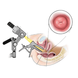 Colposcopy