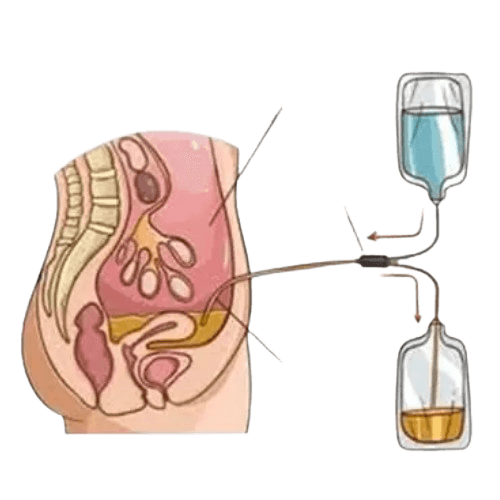 Continuous Ambulatory Peritoneal Dialysis (CAPD)