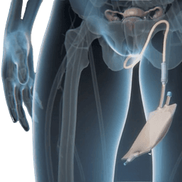 Diagnostic Laparoscopy