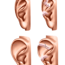 Ear Shape Correction Surgery