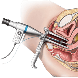 Endometrial Ablation