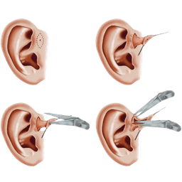 Excision of Preauricular Sinus