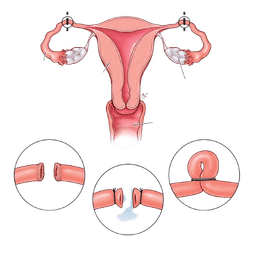 Female Sterilization – Tubectomy