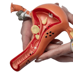 Fibroid Removal Surgery-Myomectomy