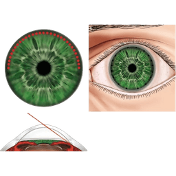 Gonioplasty (Iridoplasty)