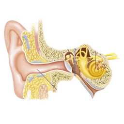 Hearing Loss - Deafness