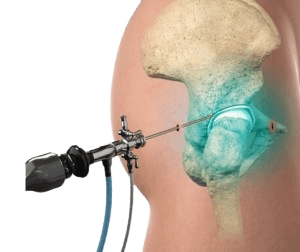 Hip Arthroscopy