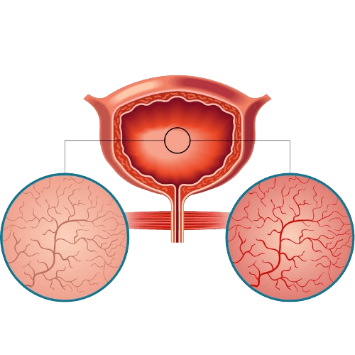 Interstitial Cystitis