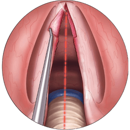 Laryngeal Web Excision
