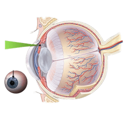 Laser Iridotomy