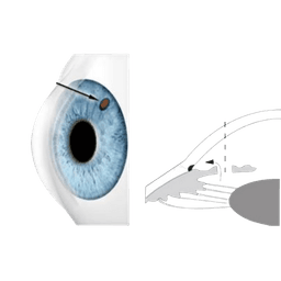 Laser Peripheral Iridotomy