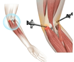 Lateral Epicondyle release (Tennis Elbow)