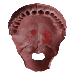 Leukoplakia Excision Surgery