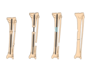 Limb Lengthening Surgery