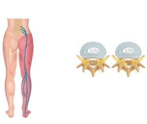 Lumbar Decompression Surgery