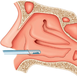Microdebrider Turbinectomy