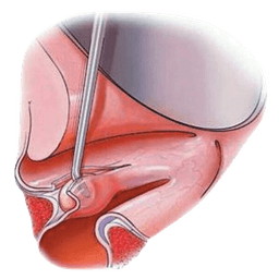 Microlaryngeal Surgery - MLS