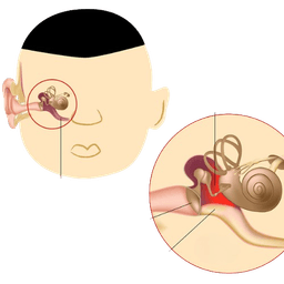 Middle Ear Infection - Otitis Media