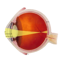 Myopia - Nearsightedness