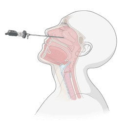 Nasal Endoscopy
