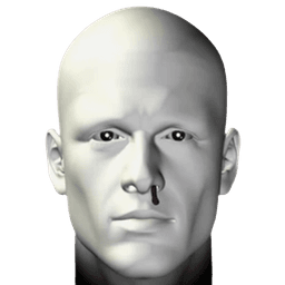 Nosebleeds - Epistaxis