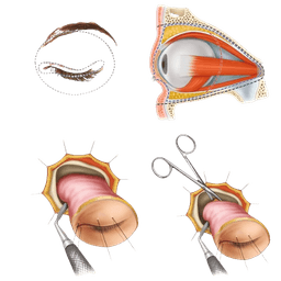 Orbital Exenteration Surgery